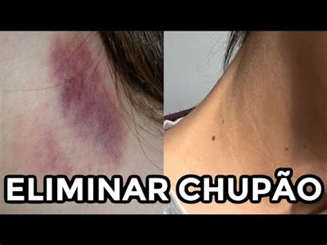 chupão no peito|Como tirar um Chupão: 5 dicas que ajudam rapidamente